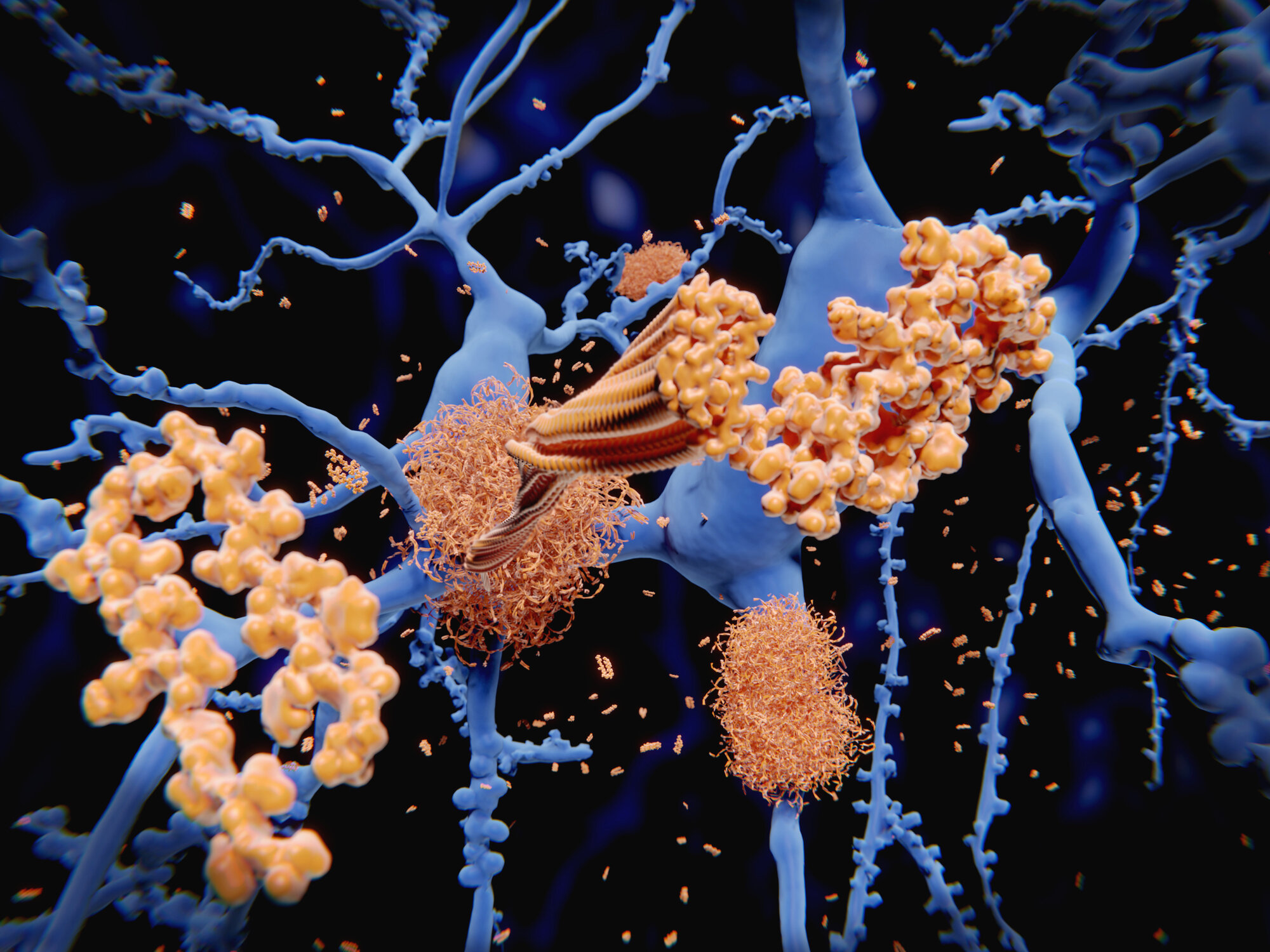 Das Alzheimeimer-Medikament Donamemab soll die Bildung von sogenannten Beta-Amyloid-Ablagerungen (Plaques) reduzieren.